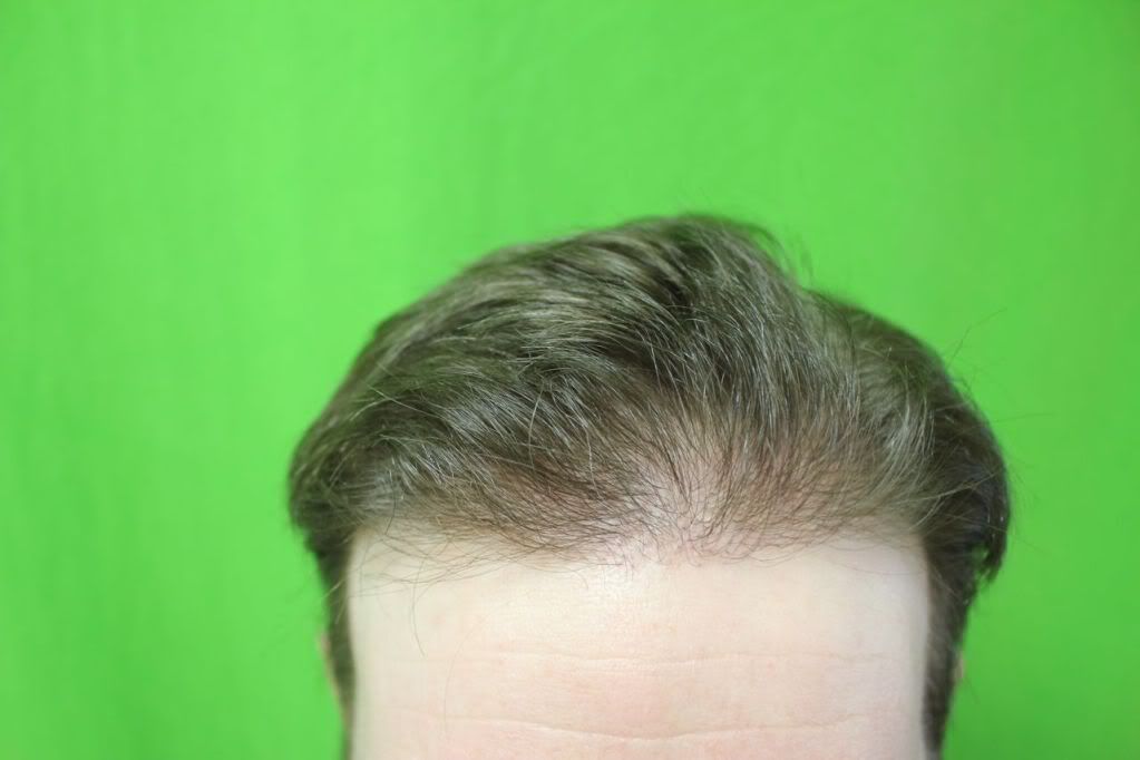 http://i1204.photobucket.com/albums/bb401/dermhair/FUEhairtransplant4-2.jpg