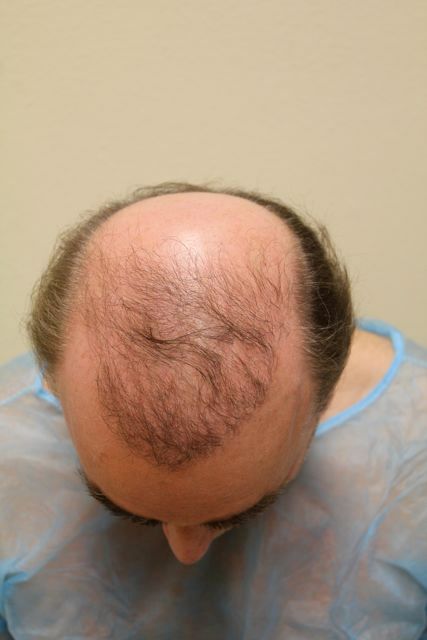 http://i1204.photobucket.com/albums/bb401/dermhair/WE/FUEhairtransplantrepair3_zpse530c439.jpg