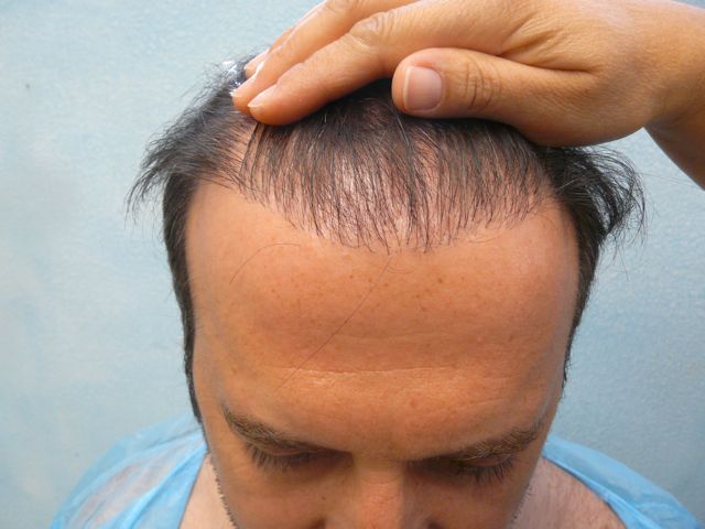 http://i1204.photobucket.com/albums/bb401/dermhair/bodyhairtransplant1.jpg