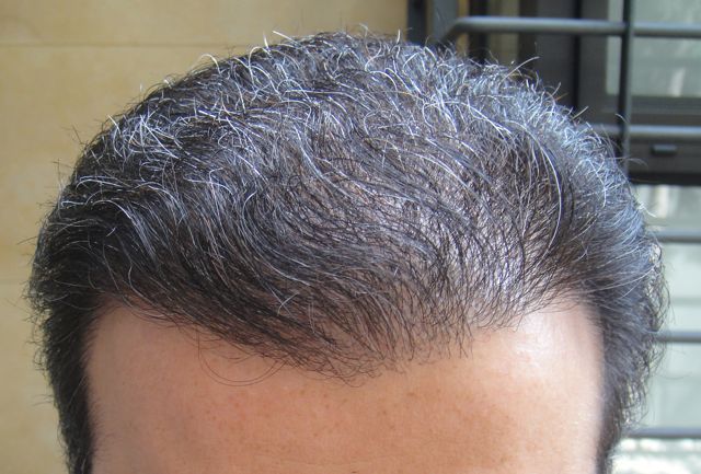 http://i1204.photobucket.com/albums/bb401/dermhair/bodyhairtransplant2-2.jpg