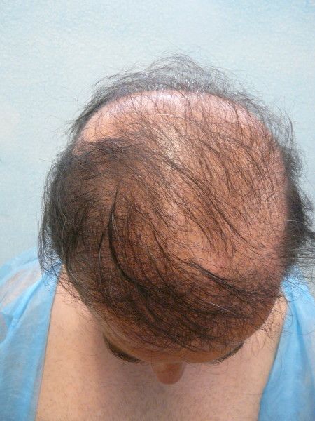 http://i1204.photobucket.com/albums/bb401/dermhair/bodyhairtransplant3-1.jpg