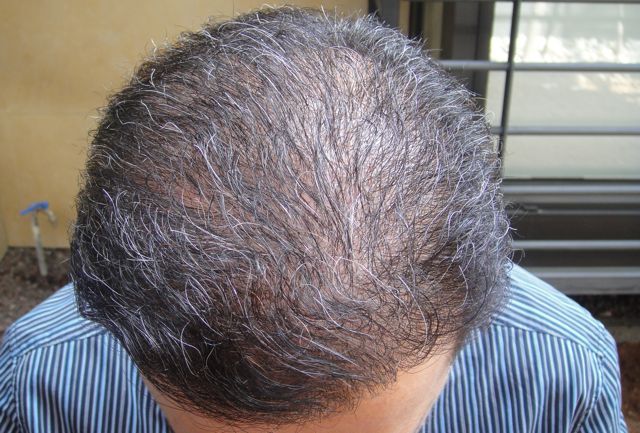 http://i1204.photobucket.com/albums/bb401/dermhair/bodyhairtransplant4-2.jpg