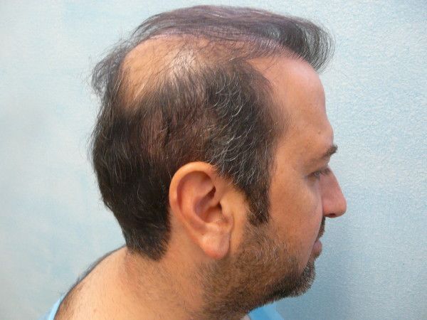 http://i1204.photobucket.com/albums/bb401/dermhair/bodyhairtransplant5.jpg