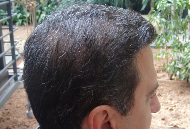 http://i1204.photobucket.com/albums/bb401/dermhair/bodyhairtransplant6-1.jpg