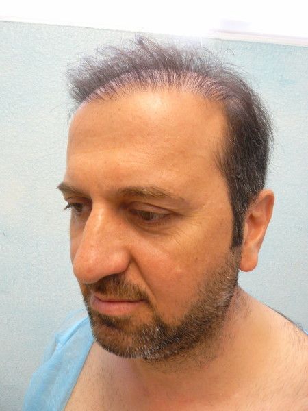 http://i1204.photobucket.com/albums/bb401/dermhair/bodyhairtransplant7.jpg