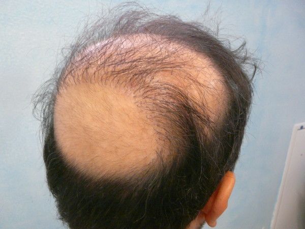 http://i1204.photobucket.com/albums/bb401/dermhair/bodyhairtransplant9.jpg