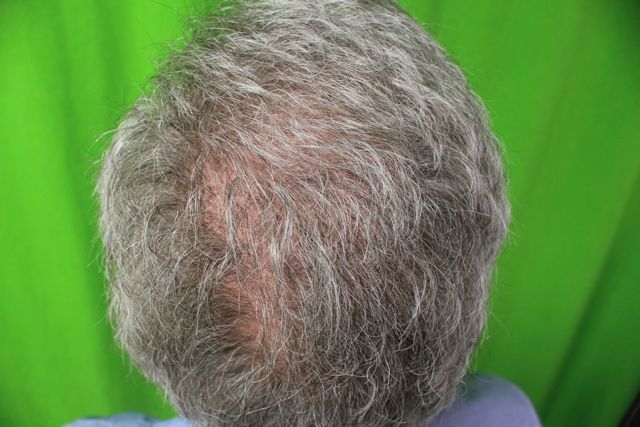 http://i1204.photobucket.com/albums/bb401/dermhair/hairtransplantrepair6.jpg