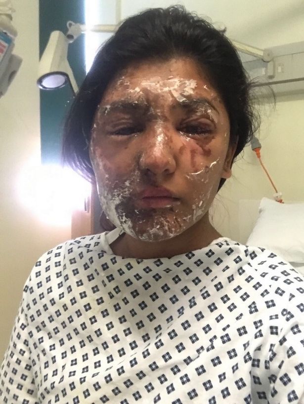 Resham Khan setelah kena cairan asam di wajahnya. (mirror)