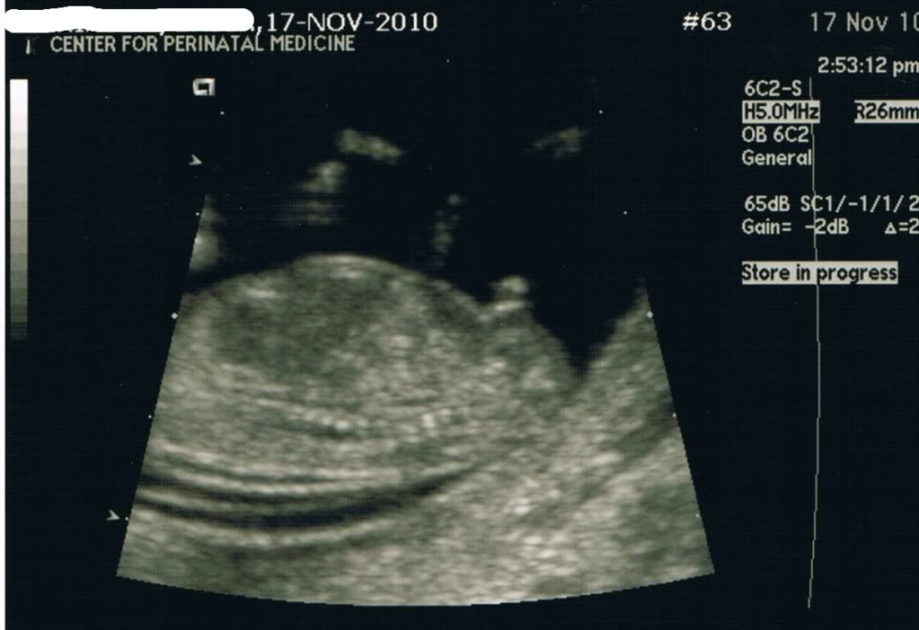 fetus at 12 weeks. fetus is indeed a boy,